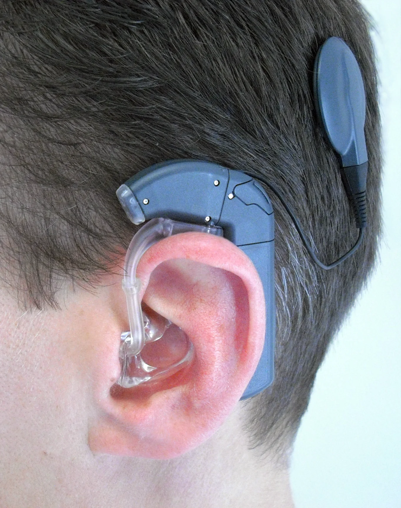 Cochlear Implant