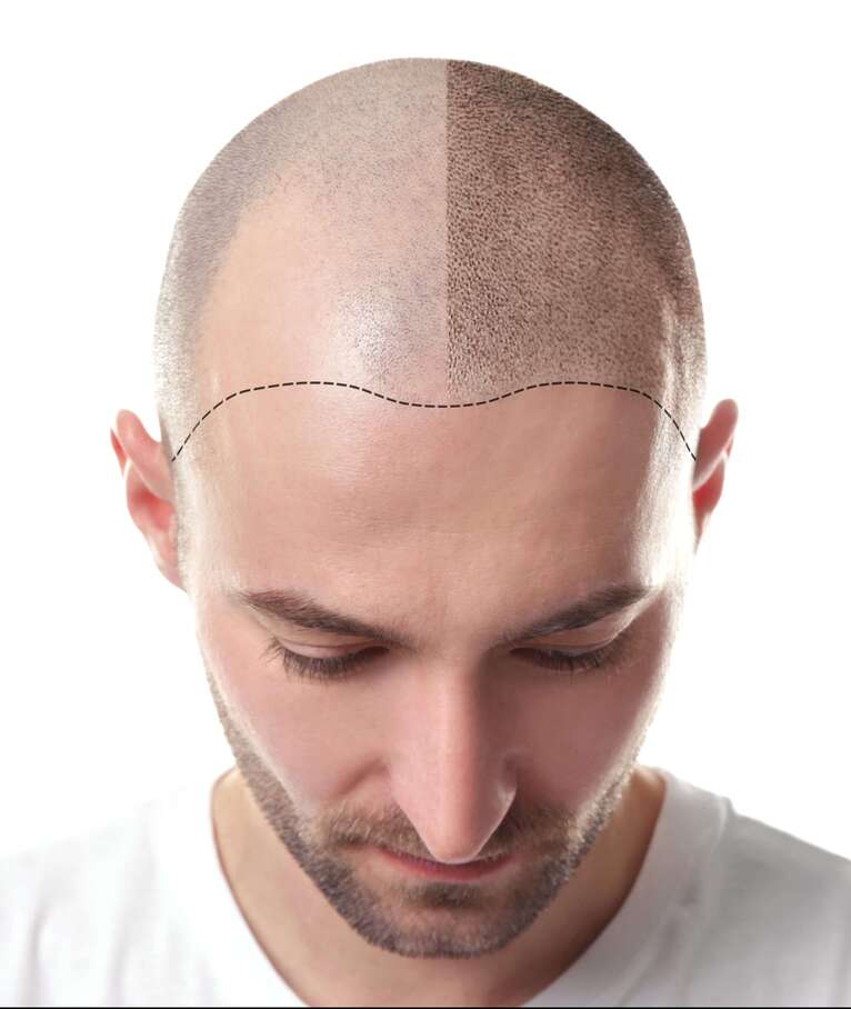 FUE Hair Transplant