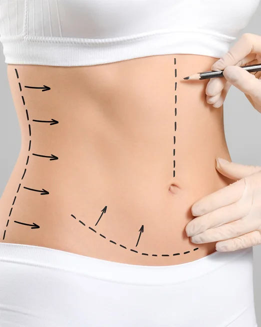 Tummy Tuck